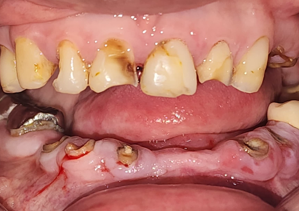 Root Canal Therapy - Before